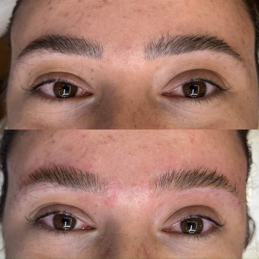 Remoção a laser de sobrancelha antes e depois em Chapecó - resultado 1