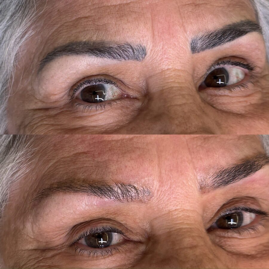 Remoção a laser de sobrancelha antes e depois em Chapecó - resultado 2