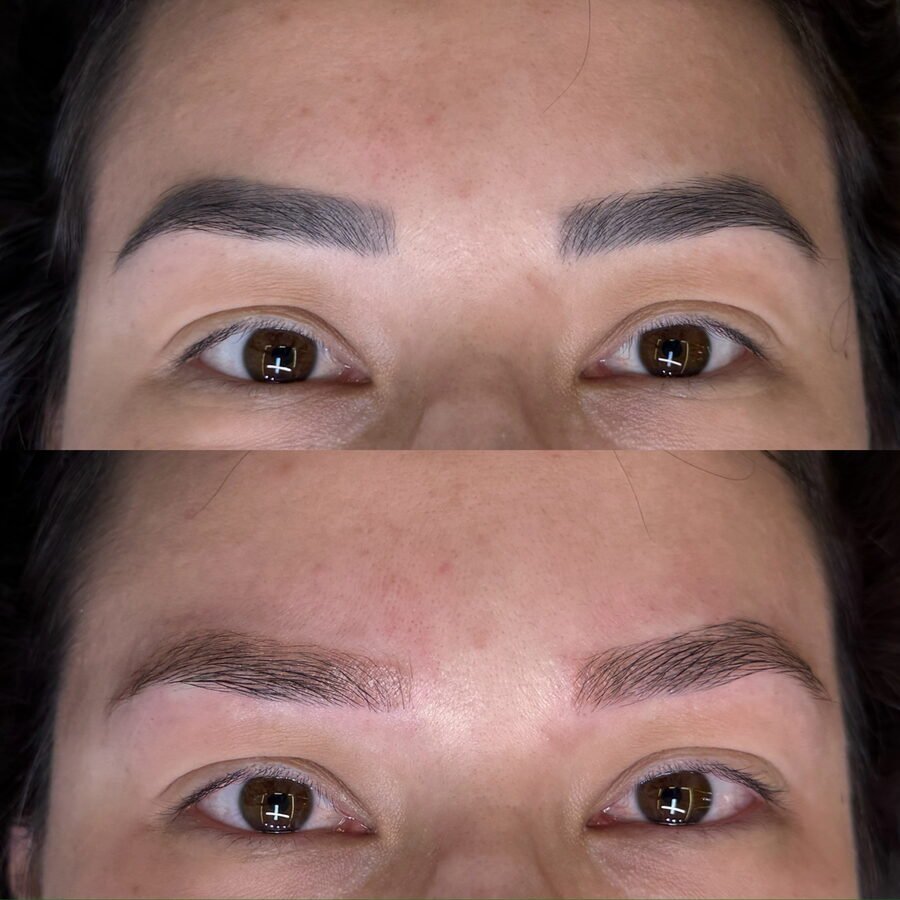 Remoção a laser de sobrancelha antes e depois em Chapecó - resultado 3