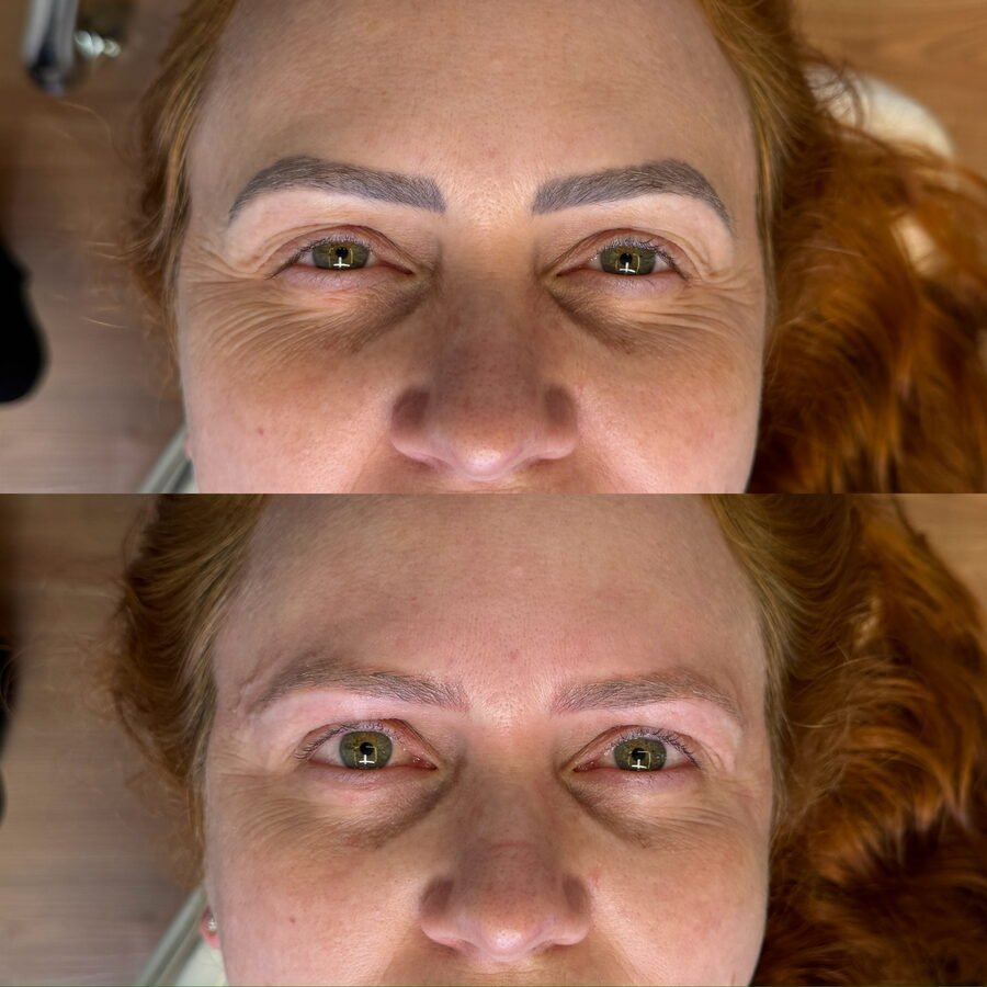Remoção a laser de sobrancelha antes e depois em Chapecó - resultado 4