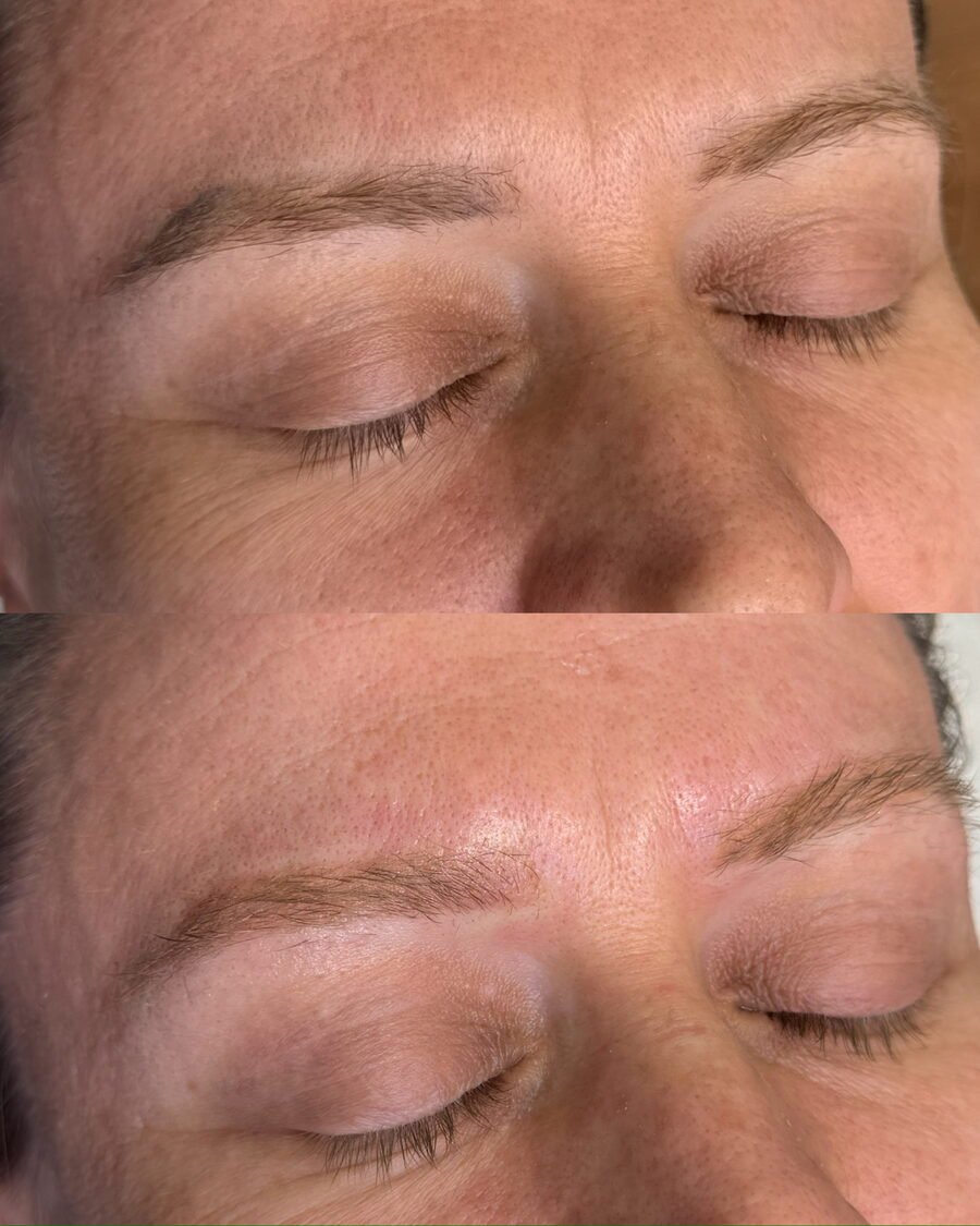 Remoção a laser de sobrancelha antes e depois em Chapecó - resultado 6