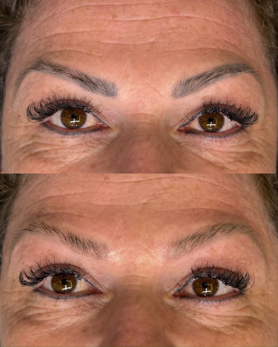 Remoção a laser de sobrancelha antes e depois em Chapecó - resultado 7