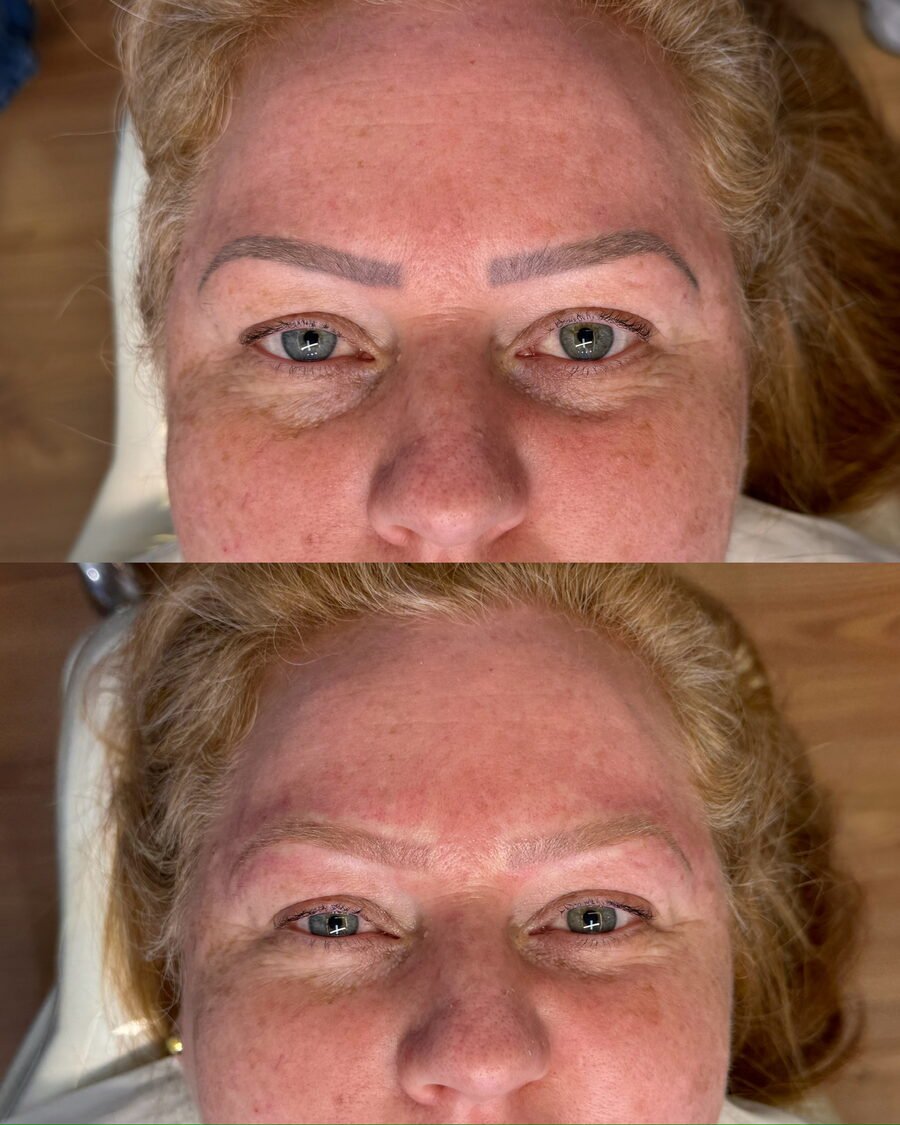 Remoção a laser de sobrancelha antes e depois em Chapecó - resultado 8