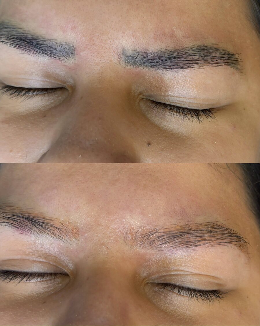 Remoção a laser de sobrancelha antes e depois em Chapecó - resultado 9