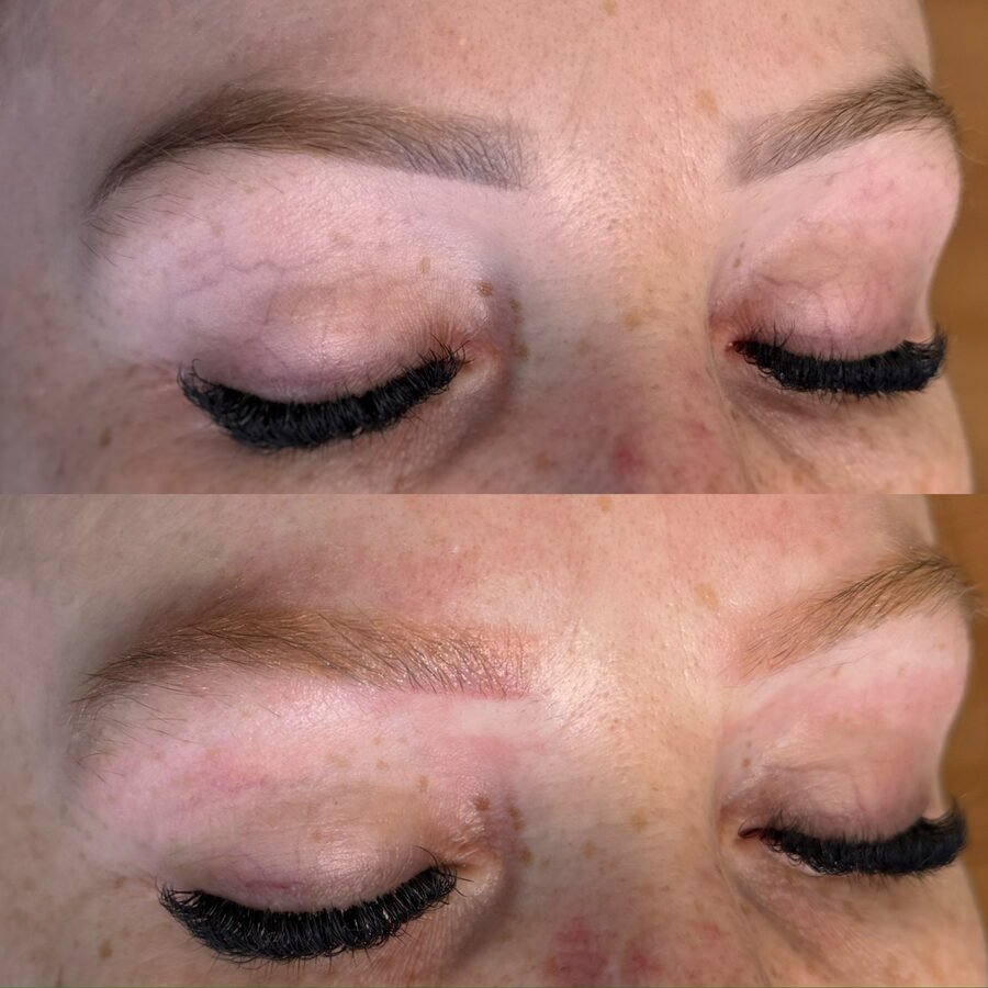 Remoção a laser de sobrancelha antes e depois em Chapecó - resultado 10