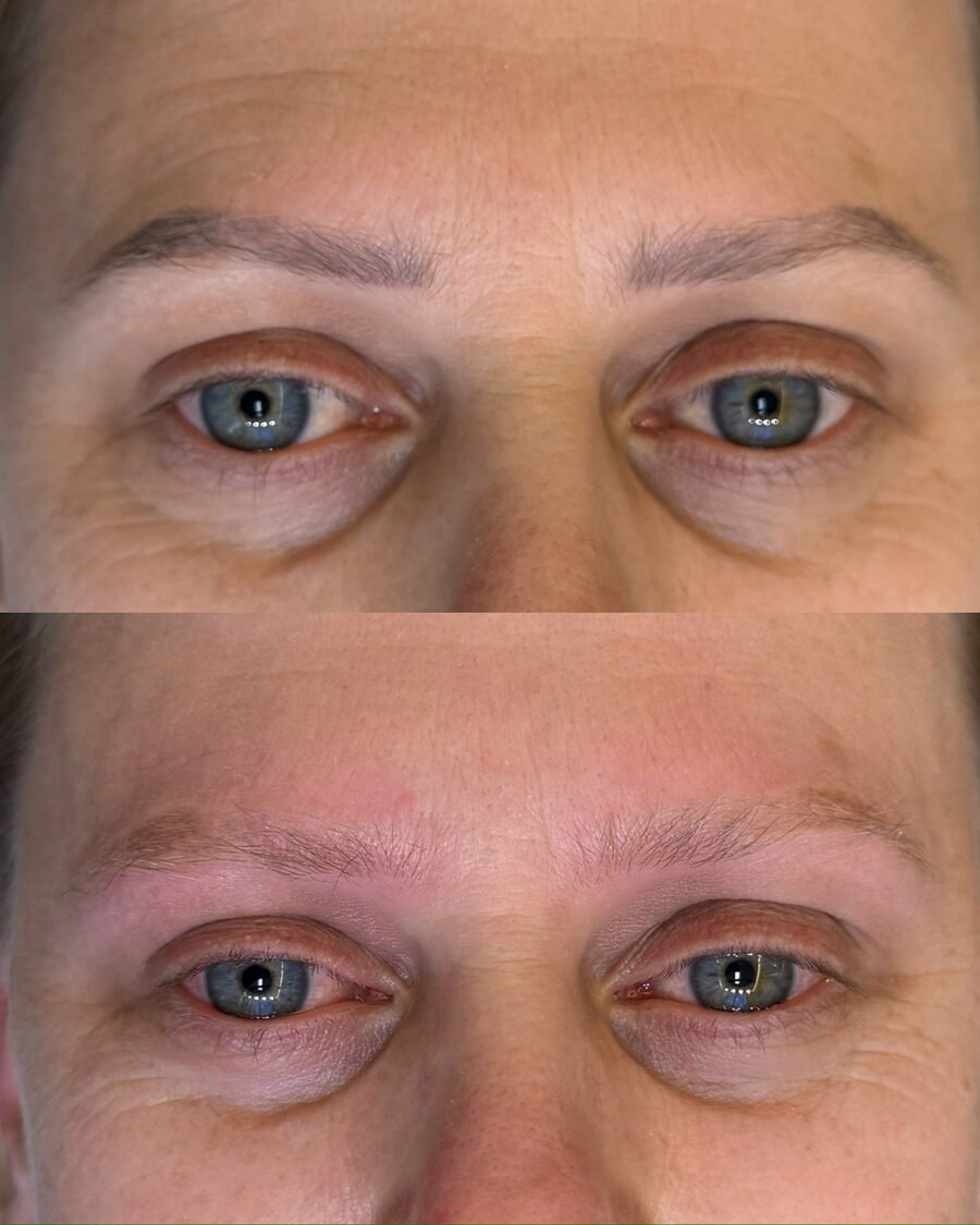 Remoção a laser de sobrancelha antes e depois em Chapecó - resultado 11