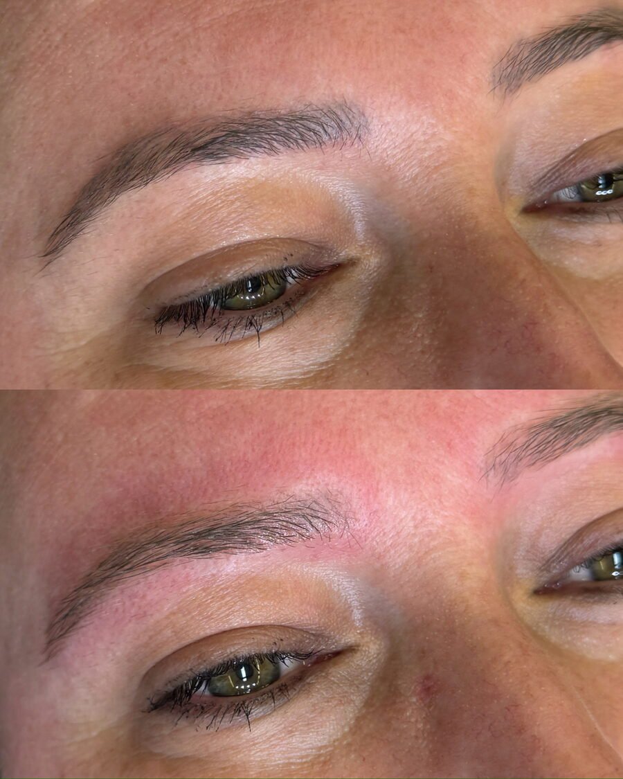 Remoção a laser de sobrancelha antes e depois em Chapecó - resultado 12