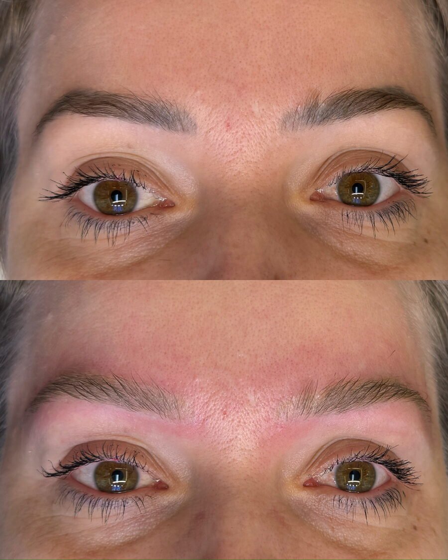 Remoção a laser de sobrancelha antes e depois em Chapecó - resultado 13