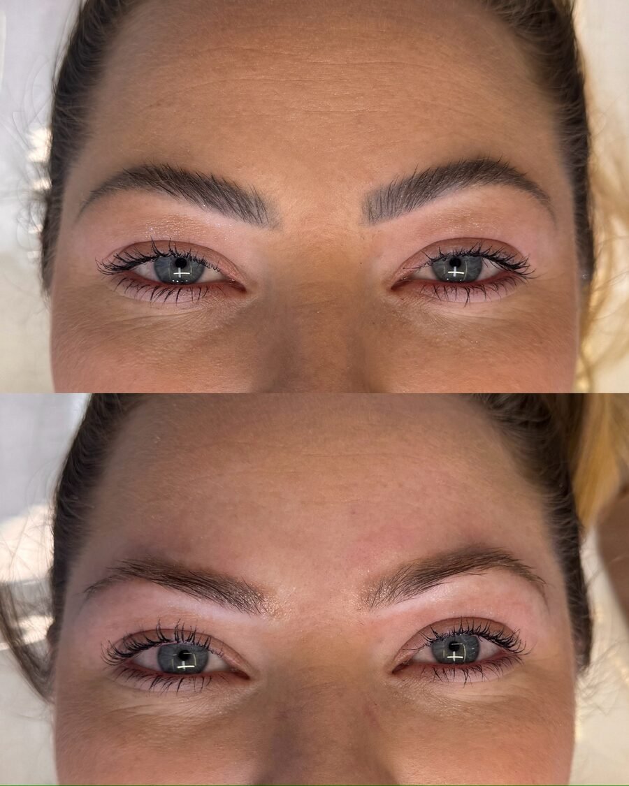 Remoção a laser de sobrancelha antes e depois em Chapecó - resultado 14