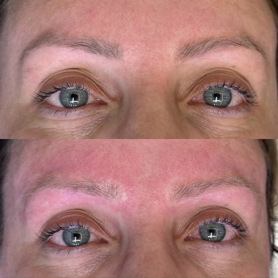 Remoção a laser de sobrancelha antes e depois em Chapecó - resultado 15