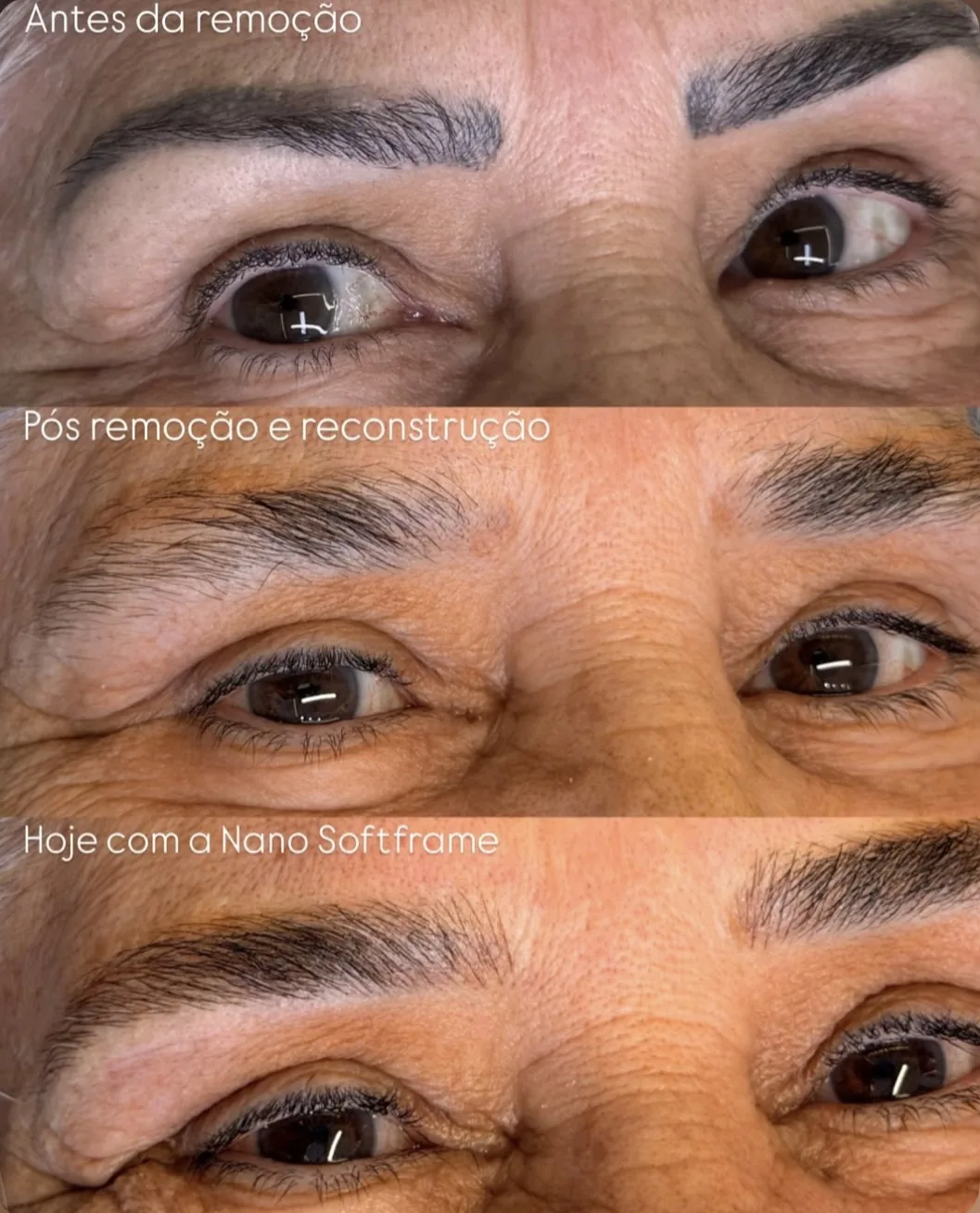 Angela: antes da remoção, pós reconstrução e hoje com a Nano Softframe