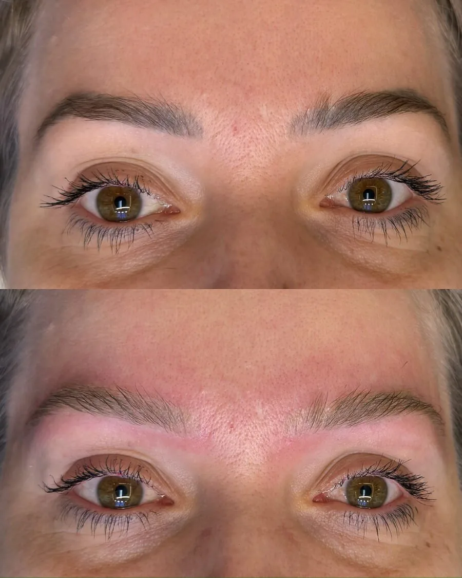 Sobrancelha antes e depois da remoção a laser