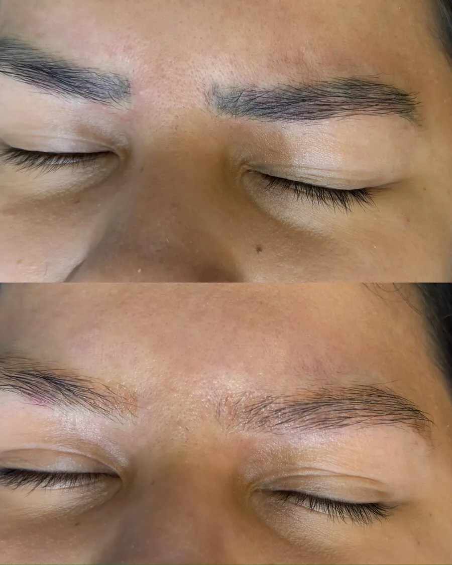 Sobrancelhas antes e depois da remoção a laser, olhos fechados