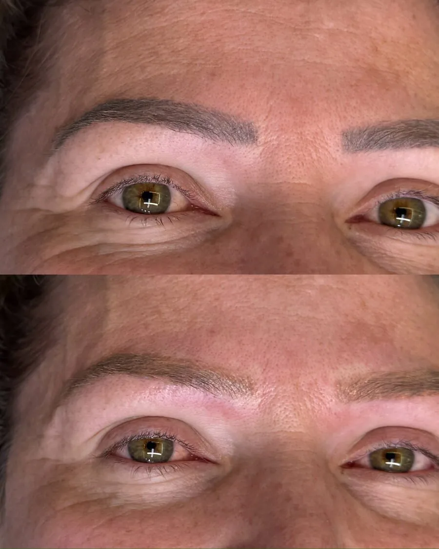 Caso recente: sobrancelha clareada pela remoção a laser, antes e depois