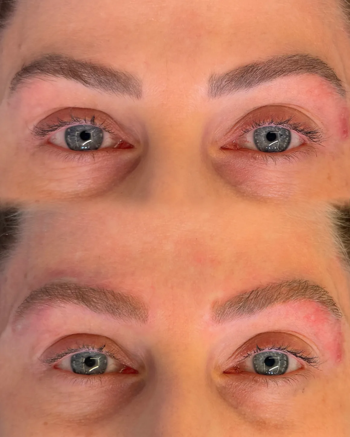 Caso recente: sobrancelhas antes e depois da remoção a laser, com os olhos visíveis