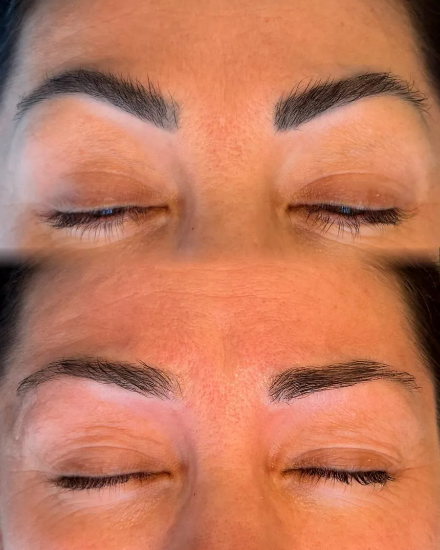 Caso recente: sobrancelhas antes e depois da remoção a laser