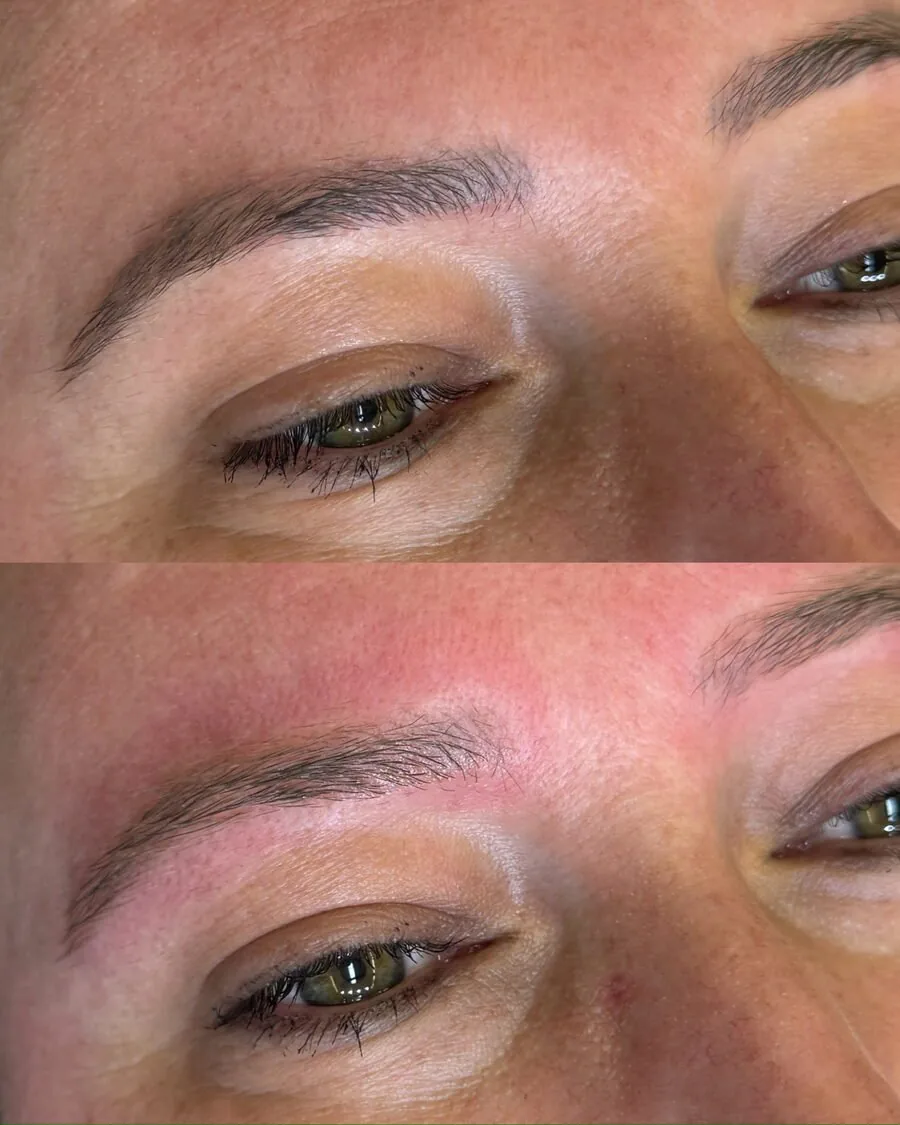 Close da sobrancelha antes e depois da remoção a laser