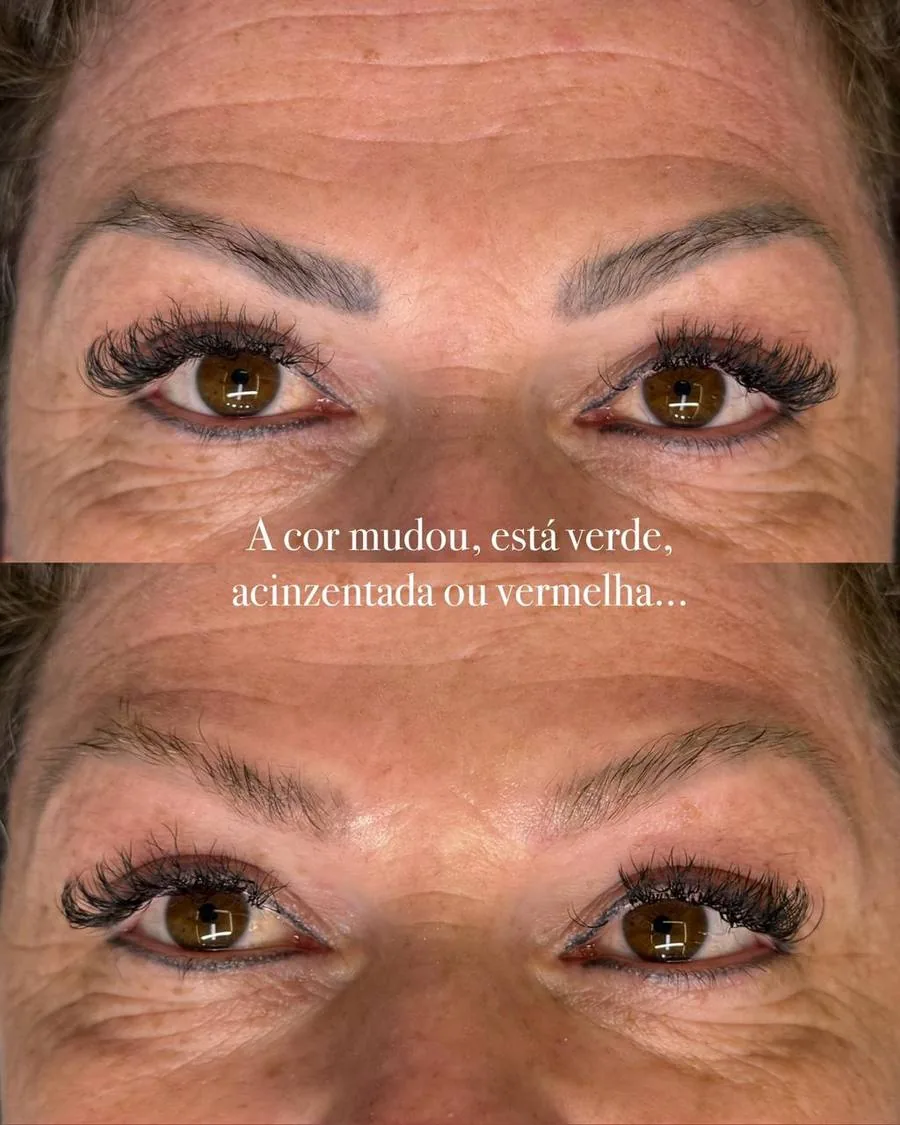 Sobrancelha antes e depois da remoção a laser, com a cor do pigmento alterada
