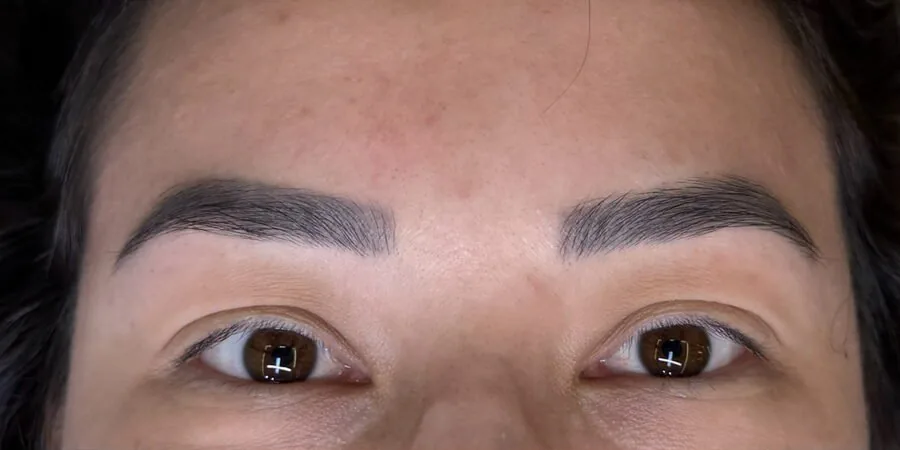 Sobrancelhas dos dois olhos antes da remoção a laser
